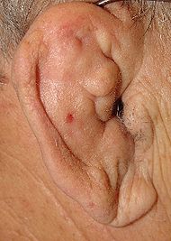 190px-Cauliflower_Ear.jpg